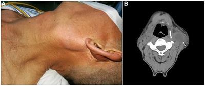 Primary or metastatic branchial cleft carcinoma?: a case report